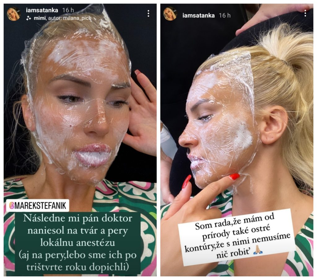 Stanka Klčová estetický zákrok