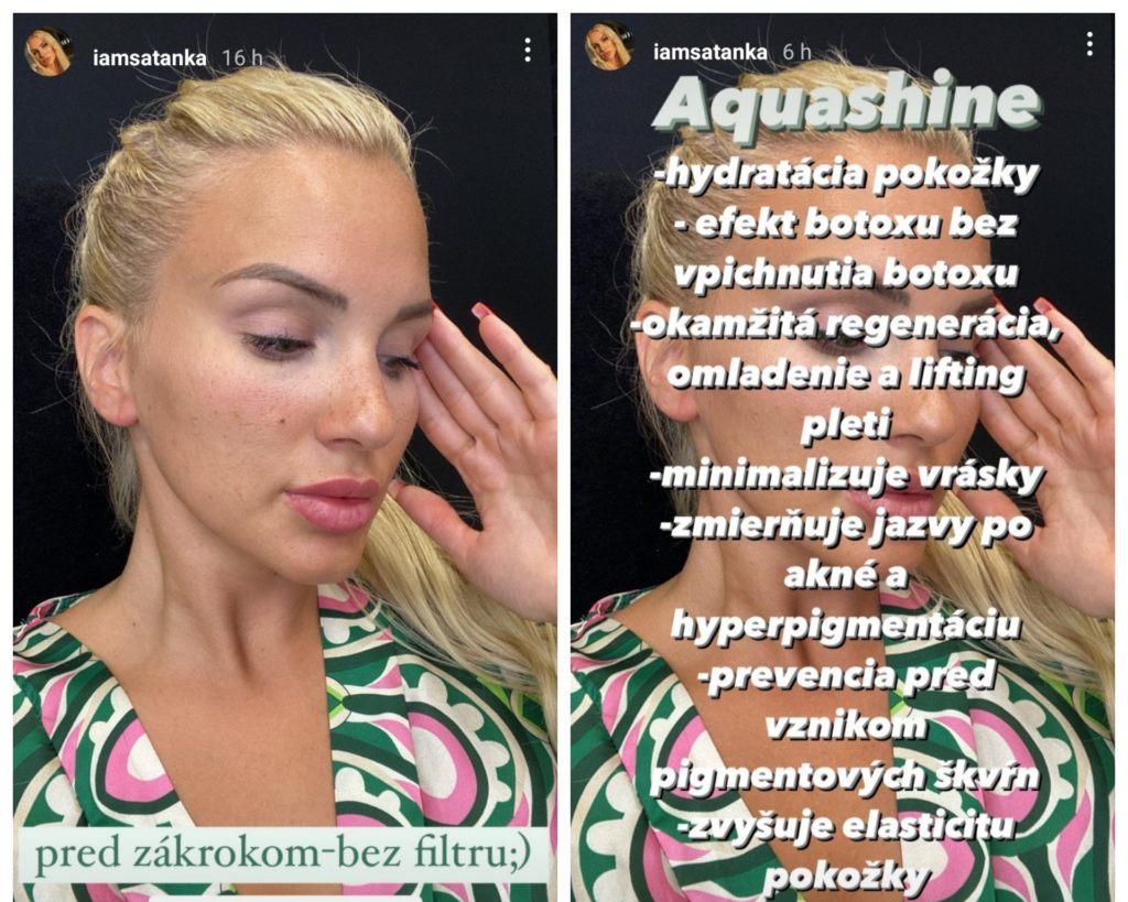 Stanka Klčová podstúpila zákrok