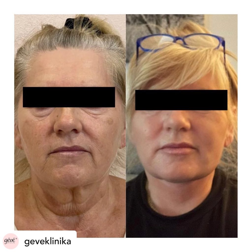 facelift