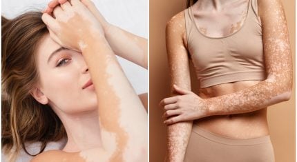vitiligo - odborník prezradil, kedy spozornieť