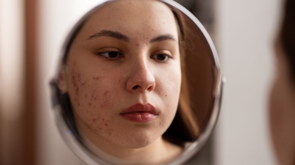 skryté príčiny akné