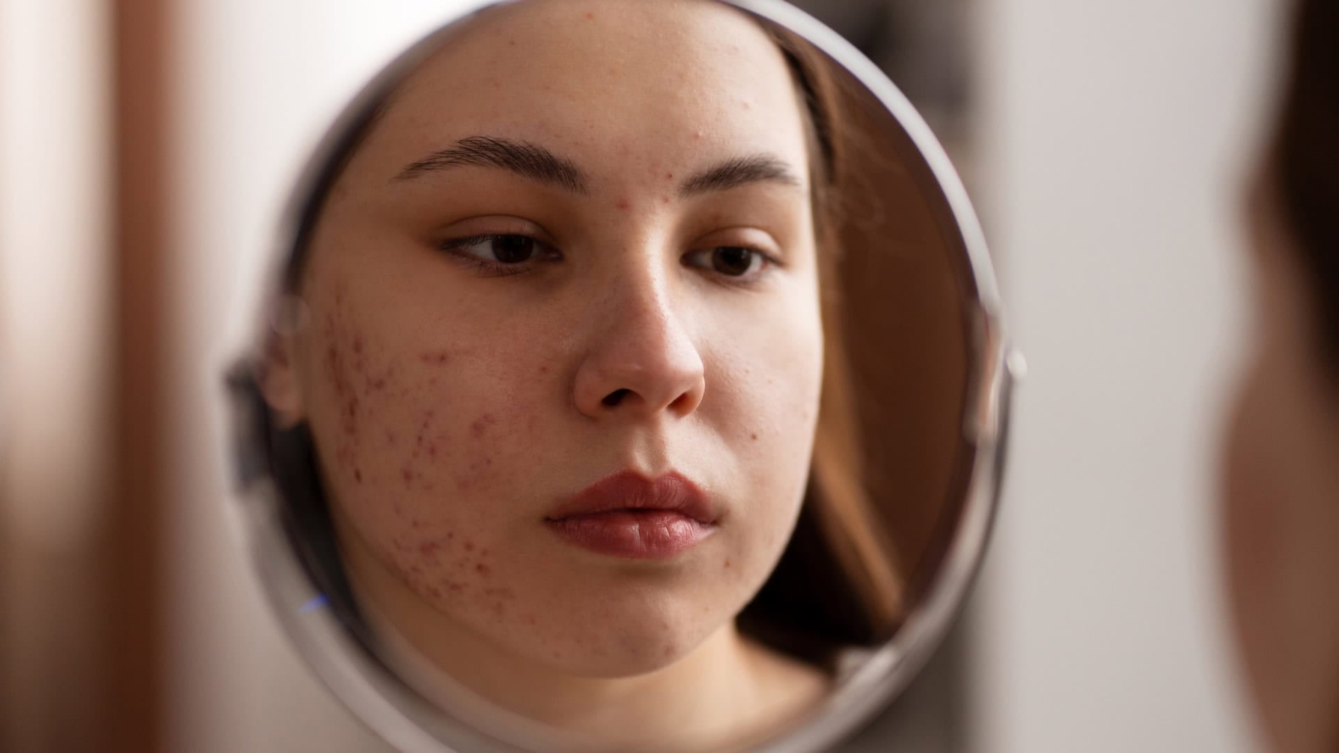 skryté príčiny akné