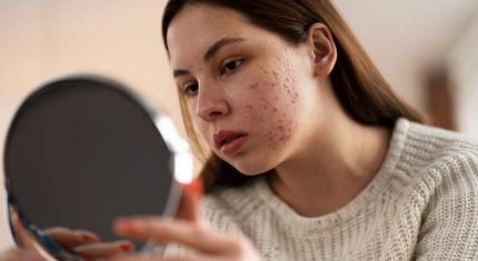 Trápi ťa akné