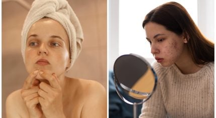 Ako bojovať s akné