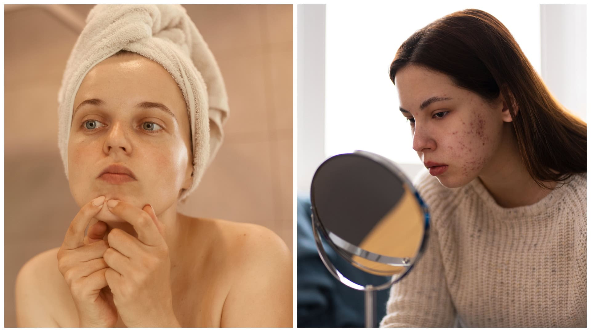 Ako bojovať s akné