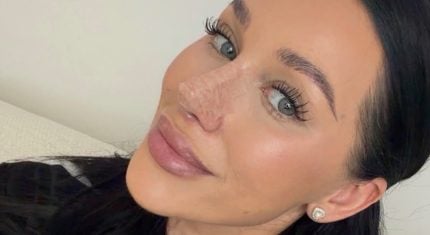 Bianka Rumanová ukázala nový nos